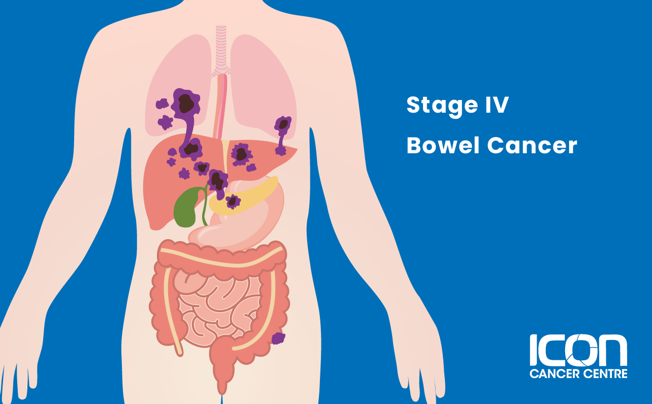 Illustration of Bowel Cancer Stage IV