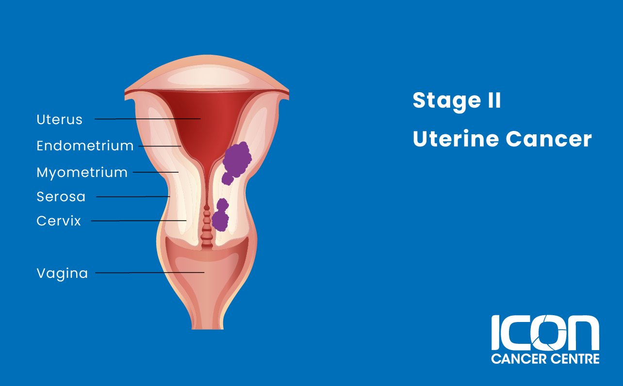 Stage II uterine cancer illustration