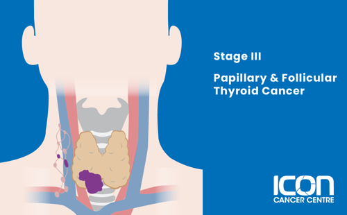 Stage III papillary and follicular thyroid cancer illustration