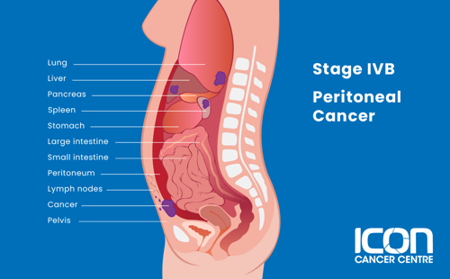 Stage IVB peritoneal cancer illustration