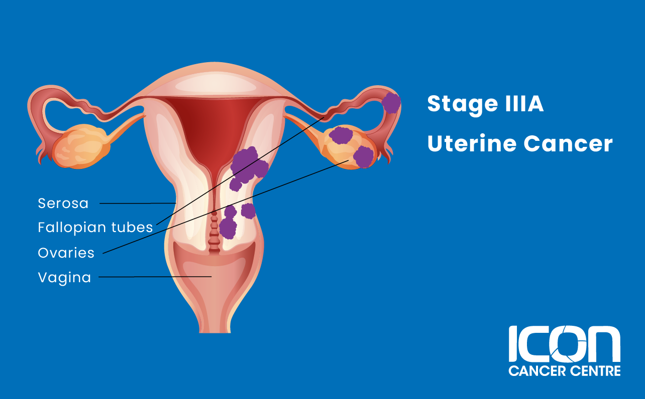 Stage IIIA uterine cancer illustration