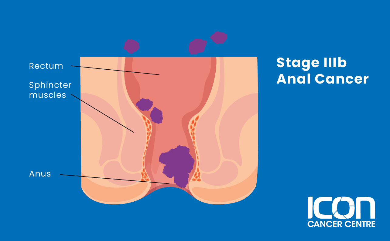 Stage IIIB anal cancer illustration