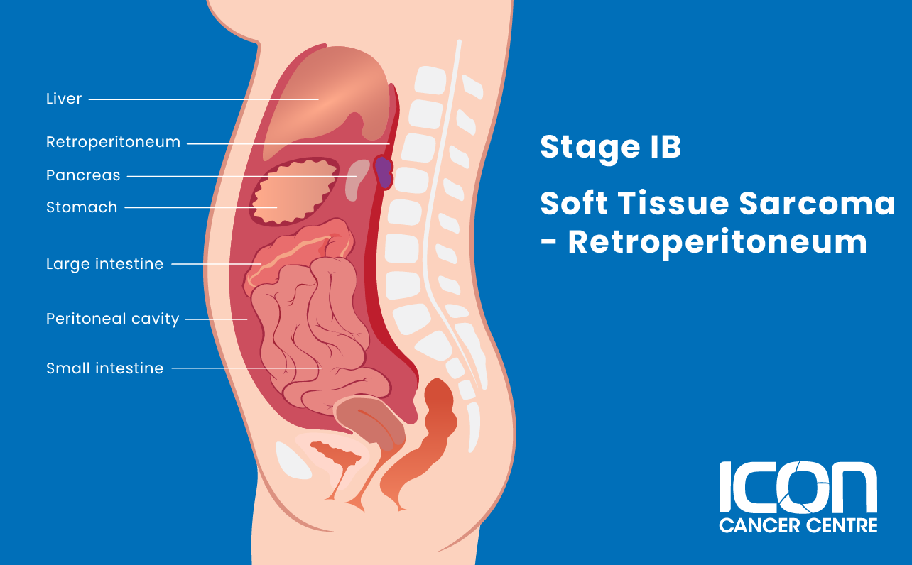 Stage IB soft tissue sarcoma in the retroperitoneum