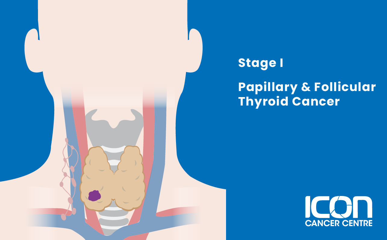 Stage I papillary and follicular thyroid cancer illustration
