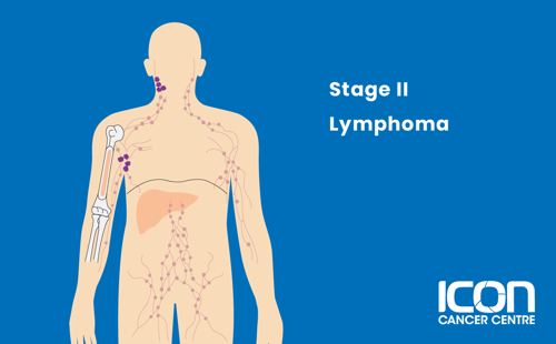 Stage II lymphoma illustration