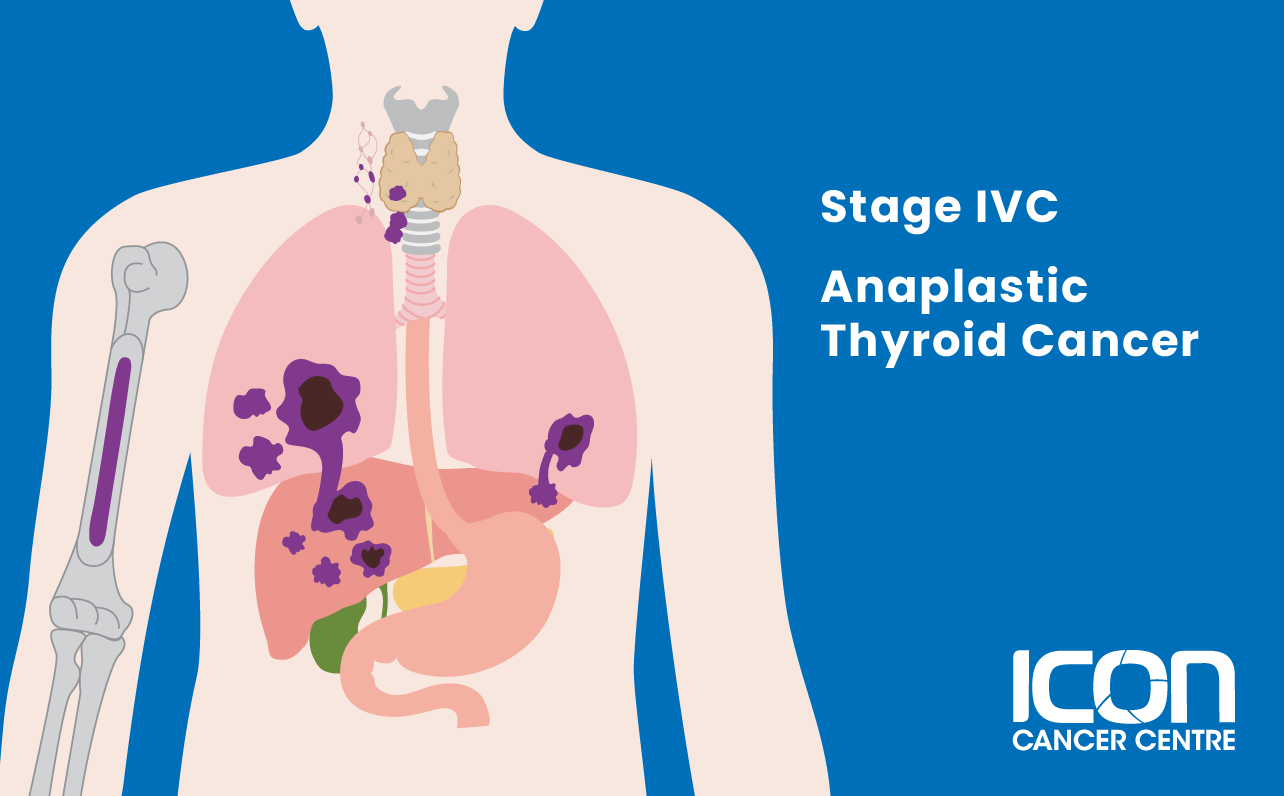 Stage IVC anaplastic thyroid cancer illustration