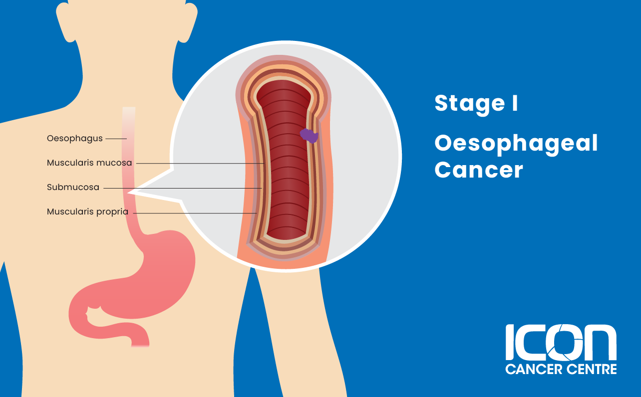 Stage I oesophageal cancer illustration