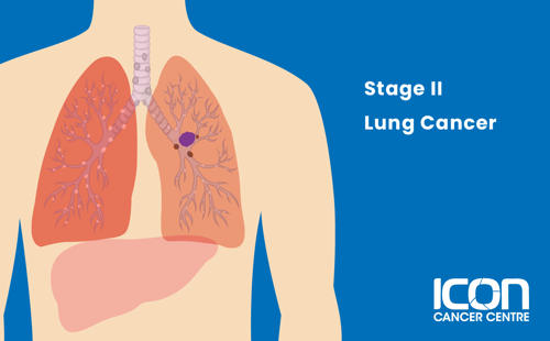 Stage II lung cancer illustration