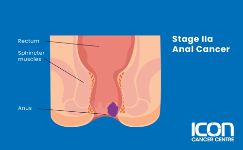 Stage IIA anal cancer illustration